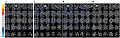 Lithium bidirectionally regulates depression- and mania-related brain functional alterations without worsening cognitive function in patients with bipolar disorder